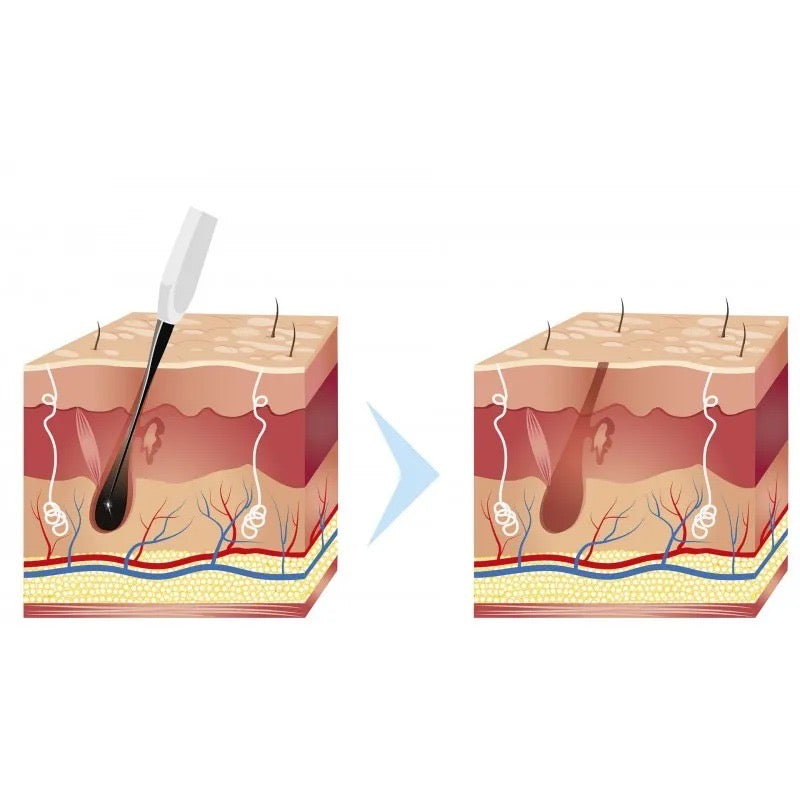Appareil Professionnel d'Electrolyse et Electrocoagulation Epilation Définitive