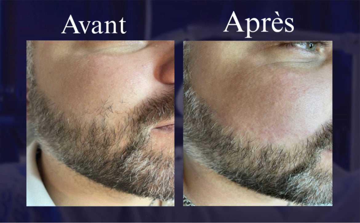 Appareil Professionnel d'Electrolyse et Electrocoagulation Epilation Définitive