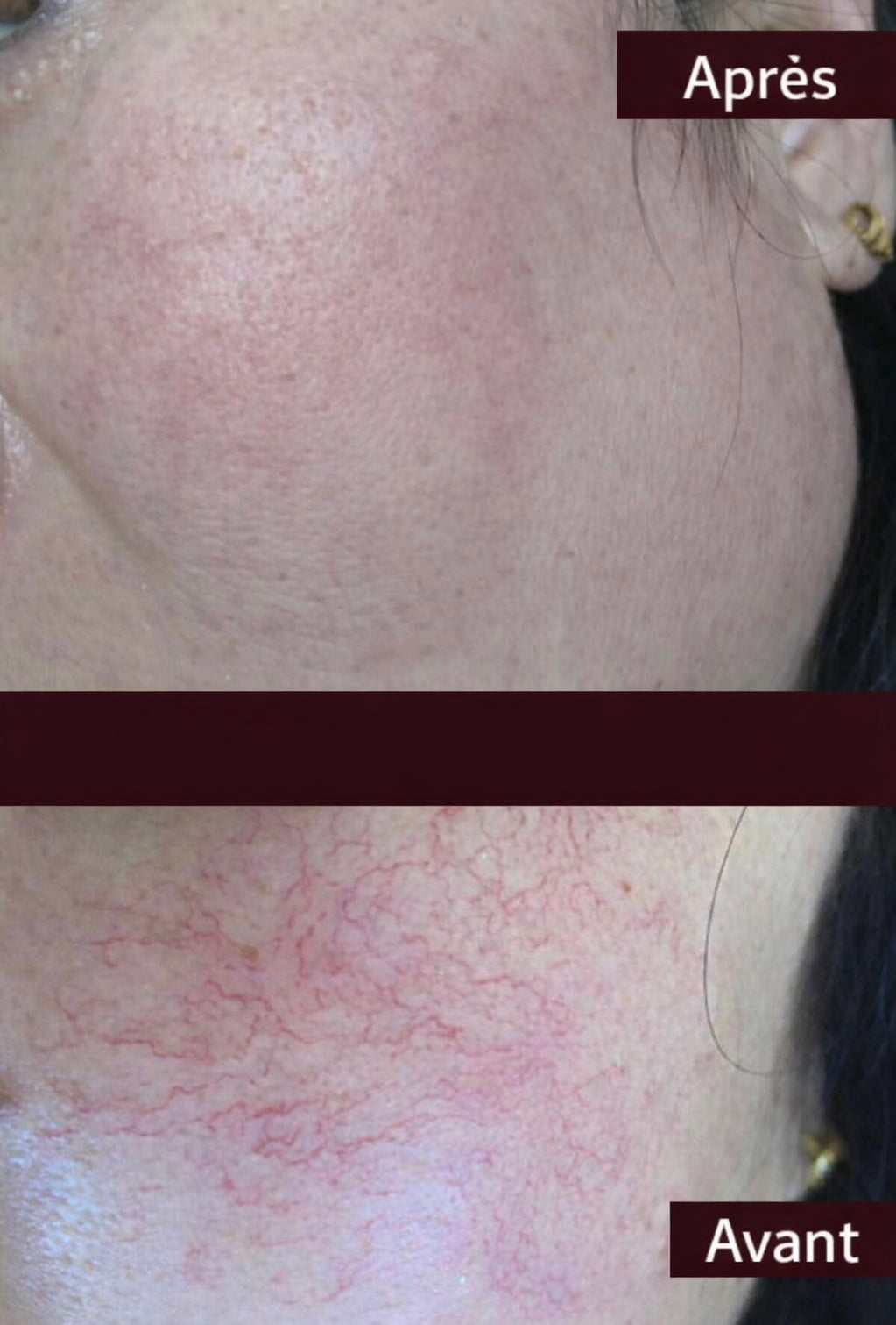 Système de Thérapie Vasculaire Dermalaz