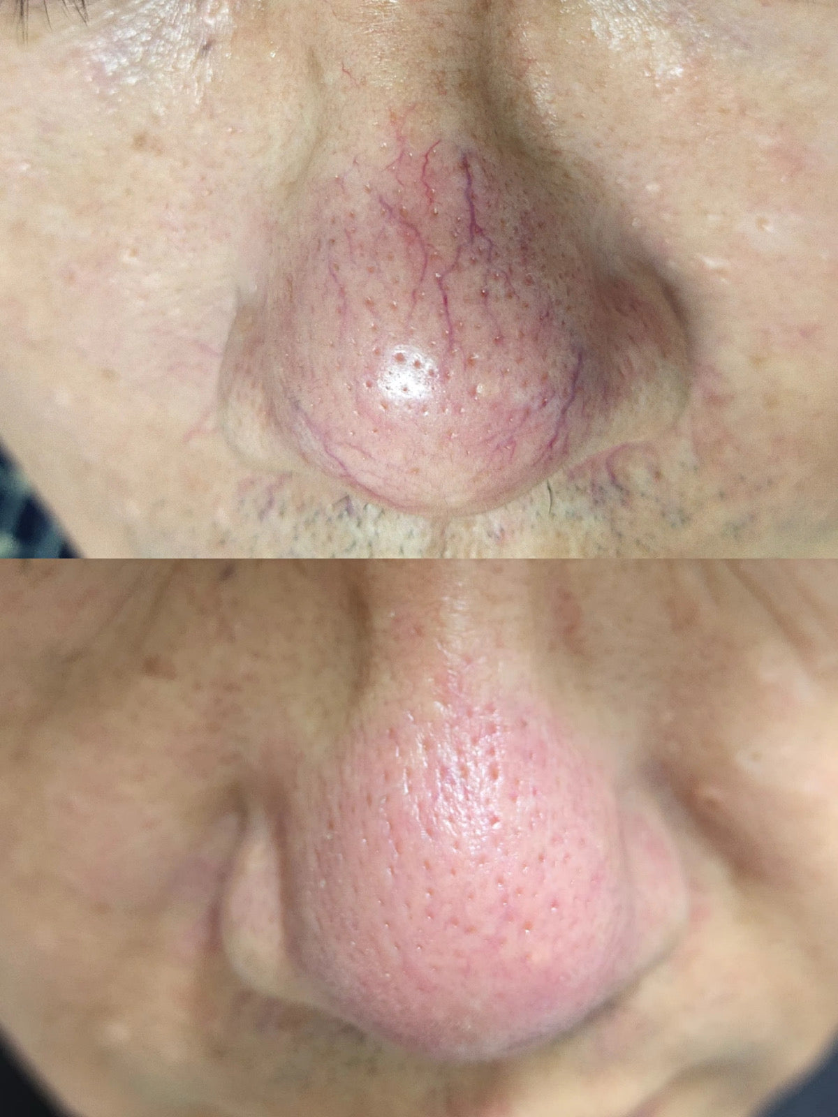 Système de Thérapie Vasculaire Dermalaz